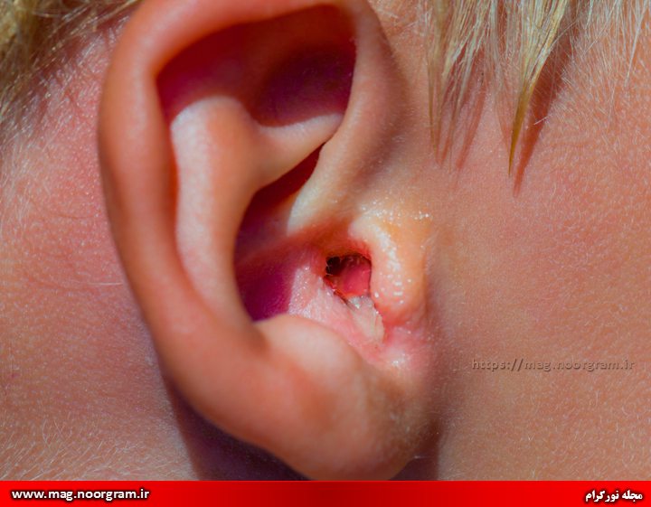 علت عفونت گوش 